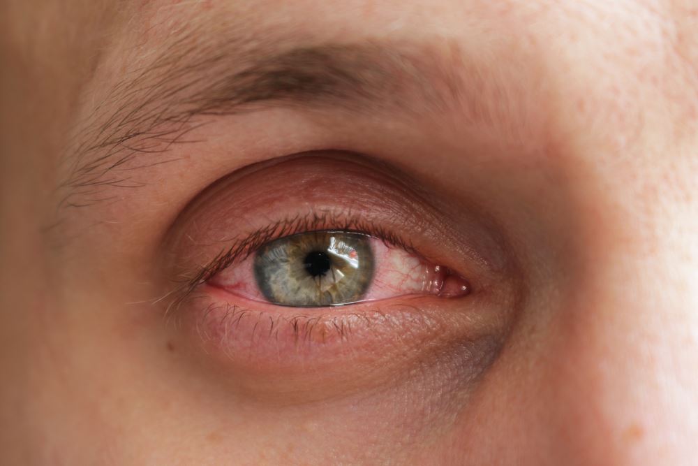 A Comprehensive Guide to Managing Dry Eye & MGD